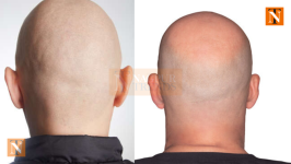Hair Loss Mystery Hits 3 Villages, Hundreds Affected
								